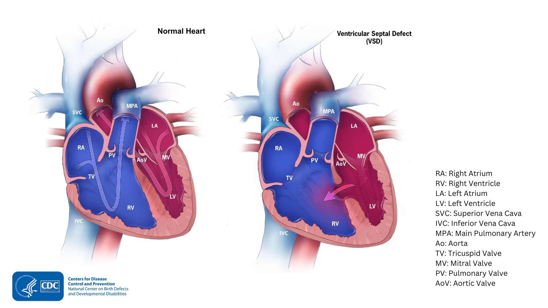 About Ventricular Septal Defect Congenital Heart Defects CHDs CDC About Ventricular Septal Defect Congenital Heart Defects CHDs CDC