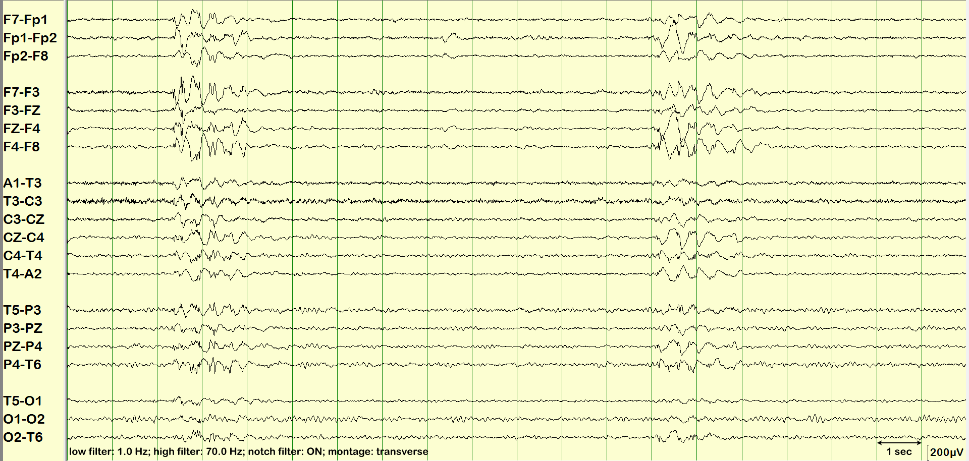 Poly Spike And Wave Poly Spike And Wave