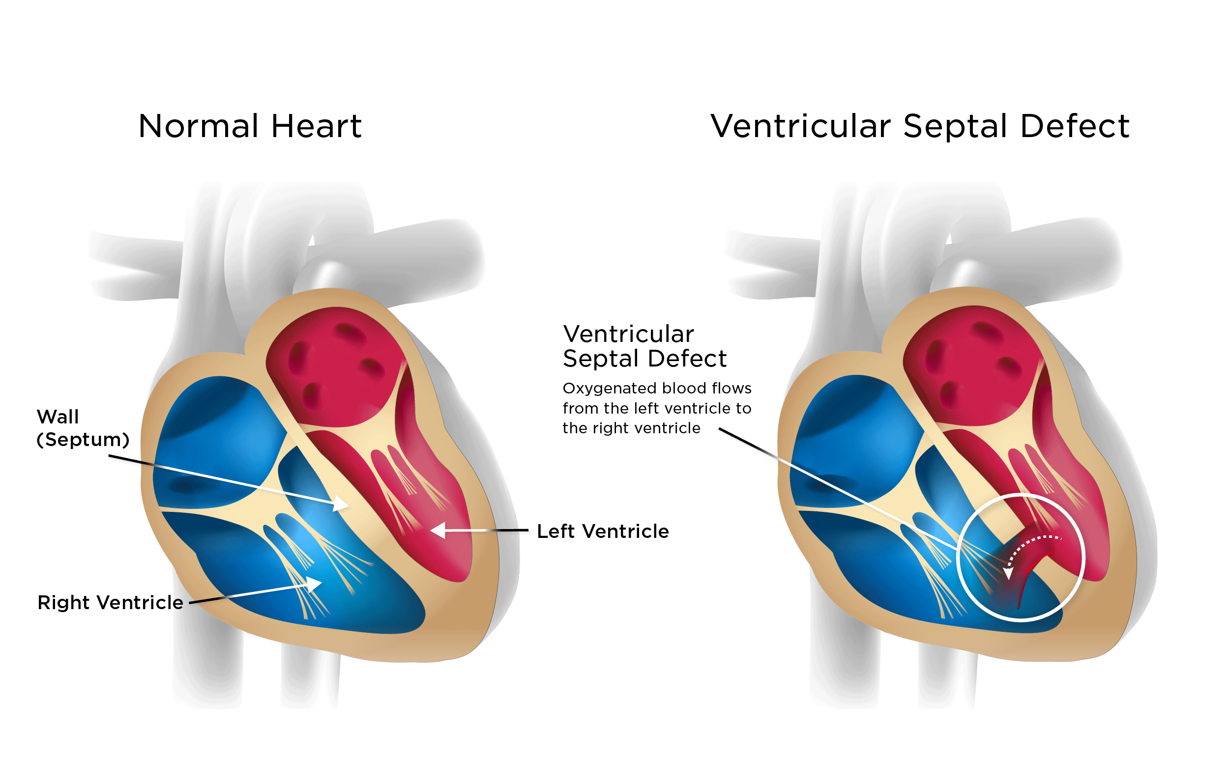 Ventricular Septal Defect Radiologi Id Vrogue co Ventricular Septal Defect Radiologi Id Vrogue co