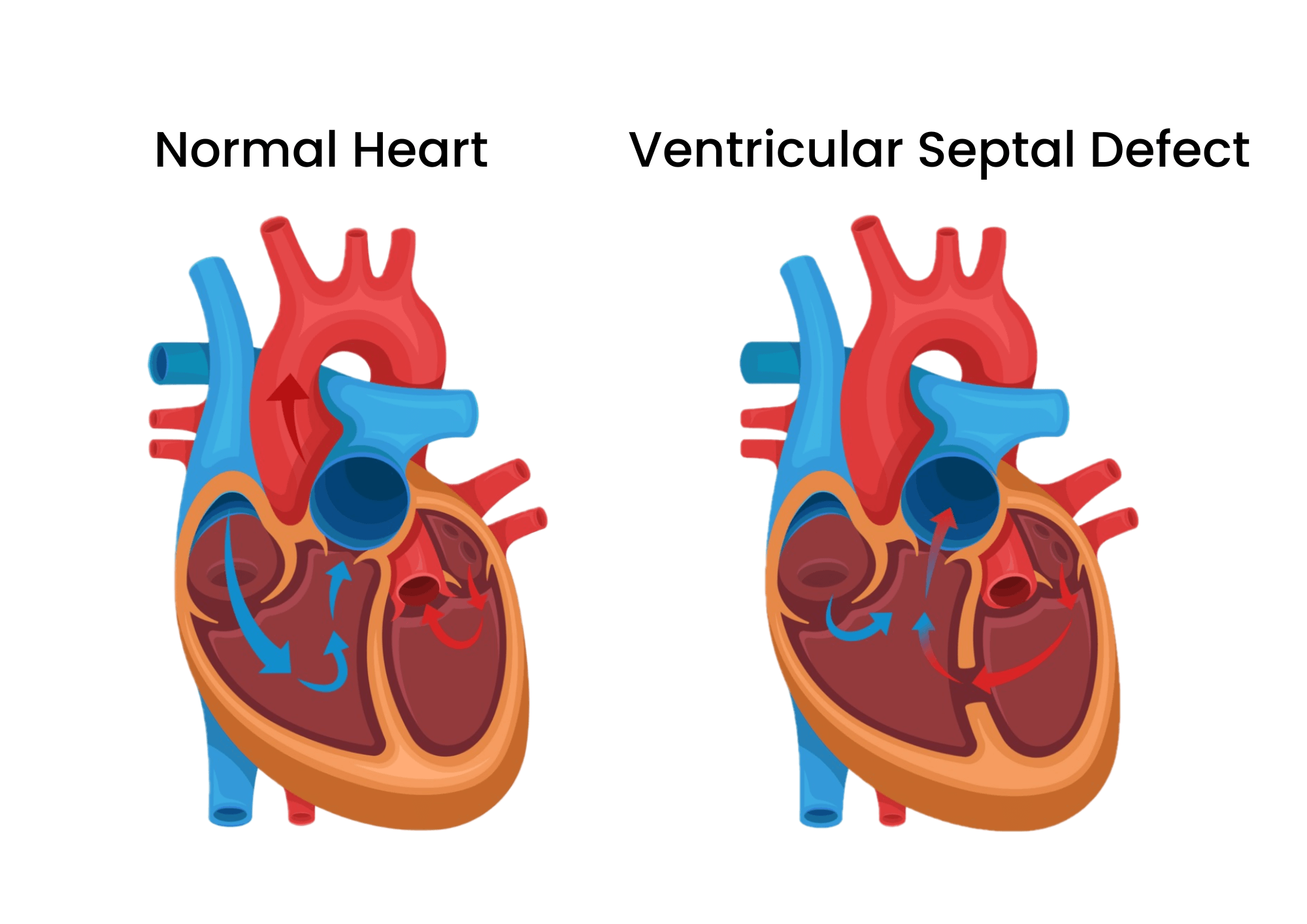 Ventricular Septal Defects VSD Dr Atul Kasliwal 39 s Blog Cardiology
